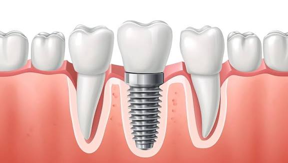 Dental Implant